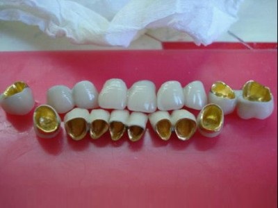 Коронки из металлокерамики с использованием платины, золота, палладия